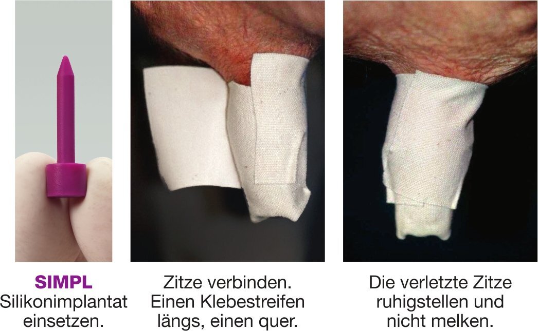 SIMPL - Das erste Silikonimplantat für Zitzen | 20er Pack von VUXXX